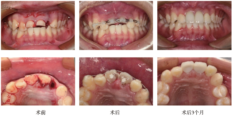 11,21牙行去髓术,内封氢氧化钙糊剂(metapex,韩国)(图2,3).