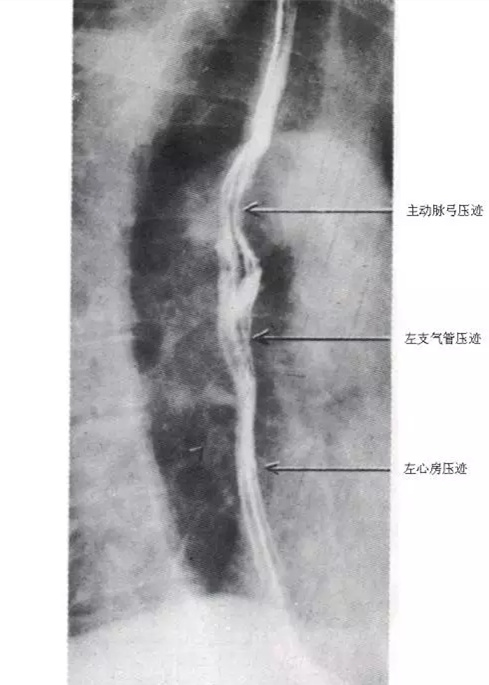 收藏 | 超详细的消化道造影解剖图谱