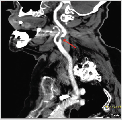 TIA诊治:遇到这3种情况,你都会处理吗?