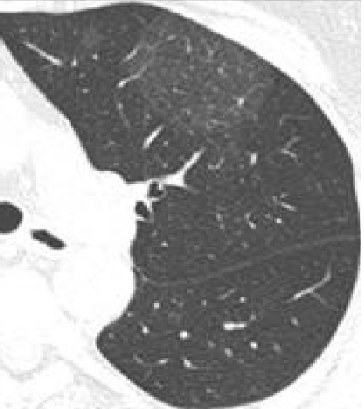 肺磨玻璃样结节鉴别诊断的几个坑,你跳过了吗