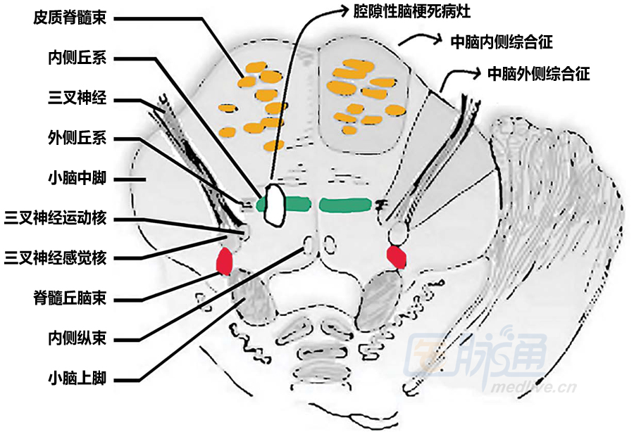 然而,脑桥病变同样与纯感觉性卒中相关,与丘脑的腔隙性脑梗死不同