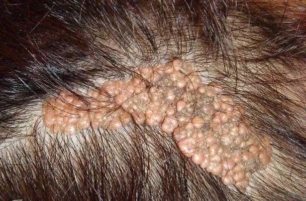 众多皮肤科的「痣」其实是错构瘤