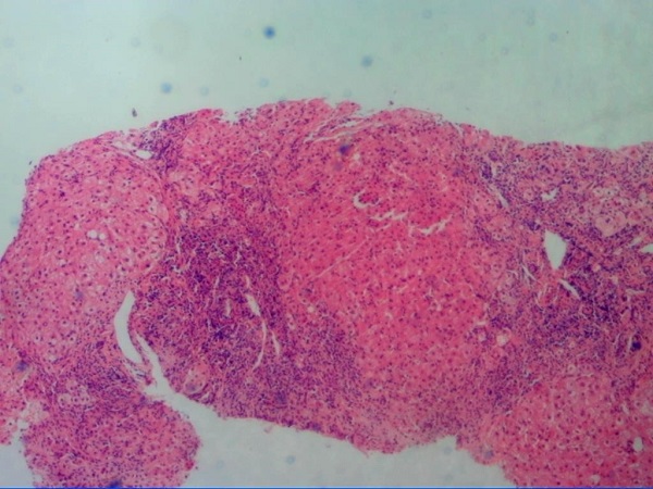 乙肝携带者怎么成了肝硬化?