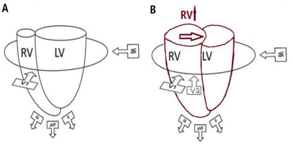 肺栓塞出现一过性T波倒置,是何原因?