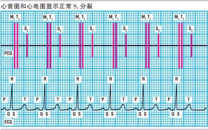 详解第一心音和第二心音,快来磨耳朵吧!|临床基