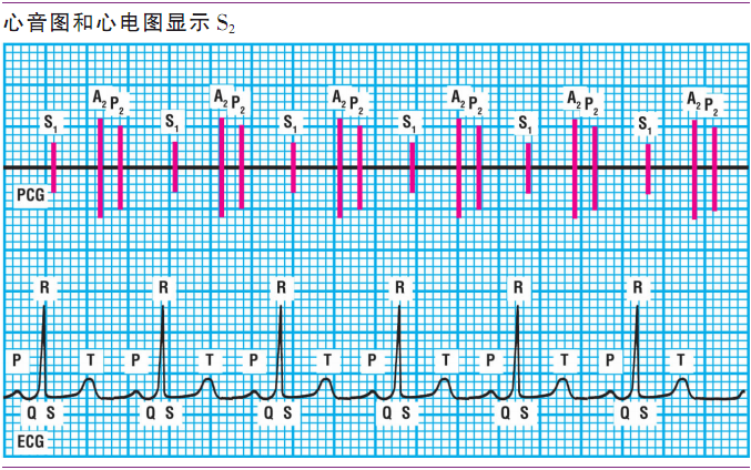 详解第一心音和第二心音,快来磨耳朵吧!|临床基