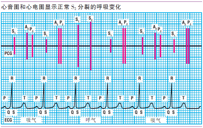 详解第一心音和第二心音,快来磨耳朵吧!|临床基