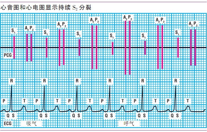 详解第一心音和第二心音,快来磨耳朵吧!|临床基