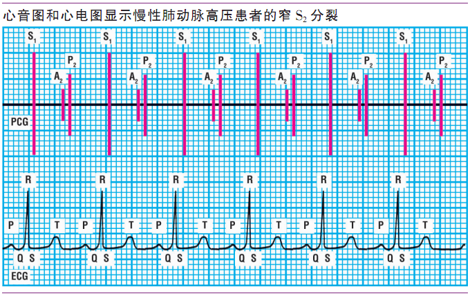 详解第一心音和第二心音,快来磨耳朵吧!|临床基