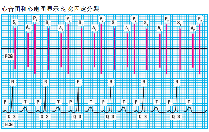 详解第一心音和第二心音,快来磨耳朵吧!|临床基