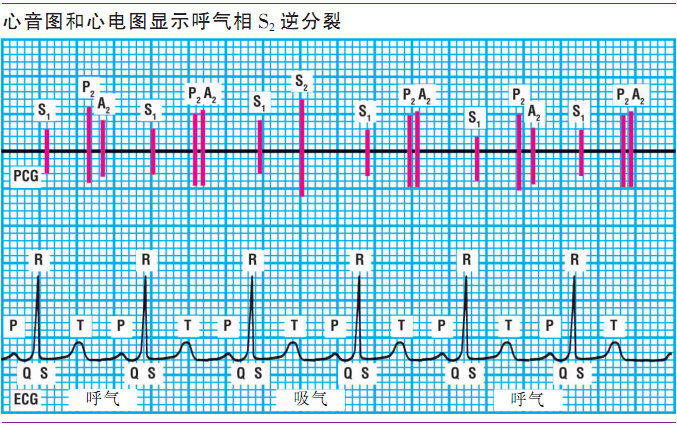 详解第一心音和第二心音,快来磨耳朵吧!|临床基