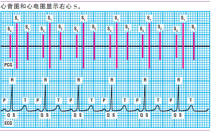 「磨耳朵」系列之第三、第四心音全解 |临床基