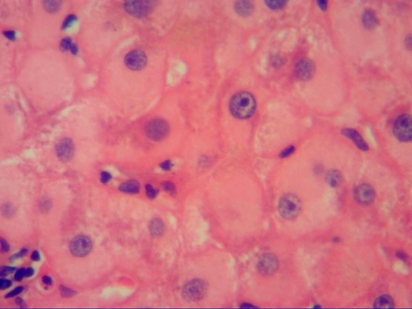 拨云见日:是慢乙肝?还是自身免疫性肝炎?