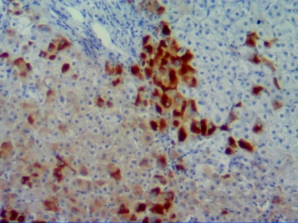 拨云见日:是慢乙肝?还是自身免疫性肝炎?