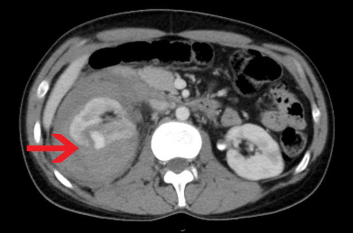 这例卒中不寻常:隐源性卒中该如何追因?