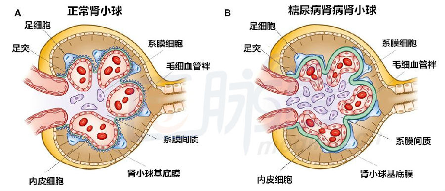 dkd患者肾脏结构可发生多种改变,发生最早的病变为肾小球基底膜增厚