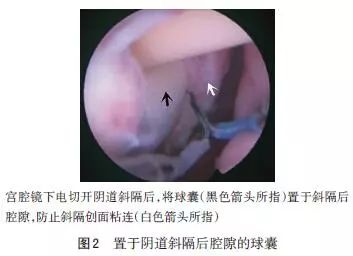 无损伤处女膜宫腔镜手术治疗阴道斜隔综合征