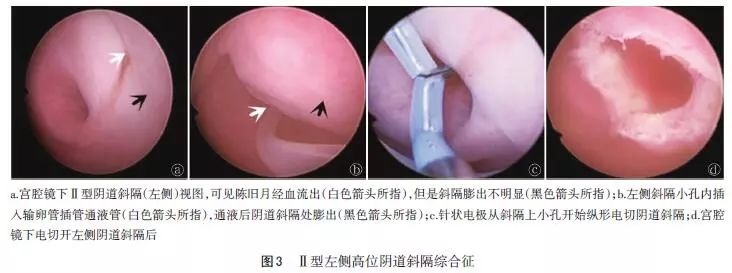 无损伤处女膜宫腔镜手术治疗阴道斜隔综合征