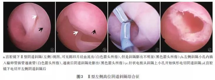 无损伤处女膜宫腔镜手术治疗阴道斜隔综合征