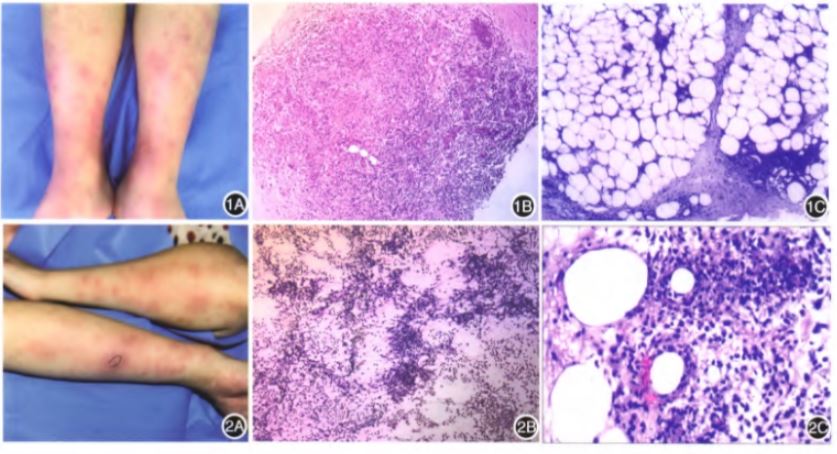 肉芽肿性乳腺炎合并结节性红斑二例