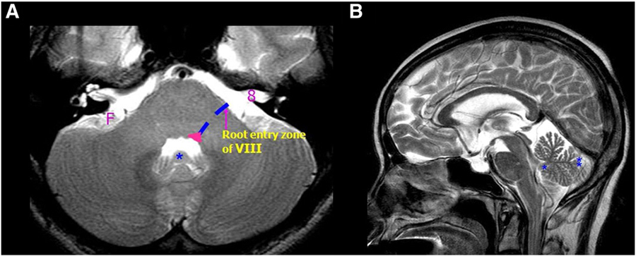 中枢性急性前庭综合征:眩晕的重要原因|一文读