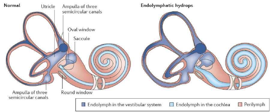 梅尼埃病五大要点,也许你并不知道
