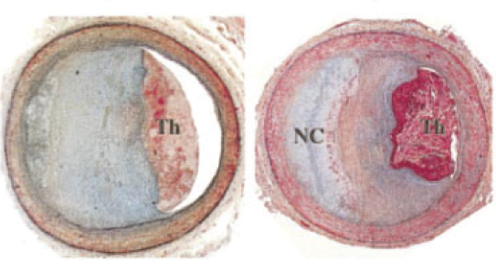 冠脉病变分析与新型支架比较的OCT最新研究