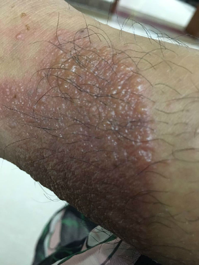 一文解析接触性皮炎