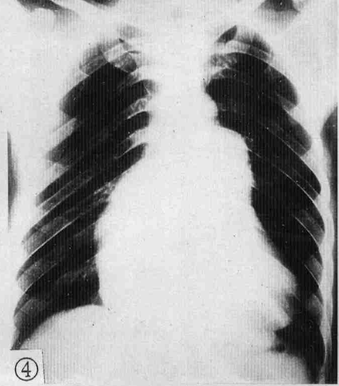 循环系统在胸片上的异常表现 |基础篇