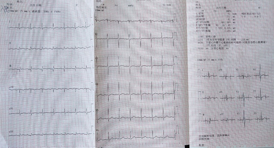 从一个病例认识Wellens综合征