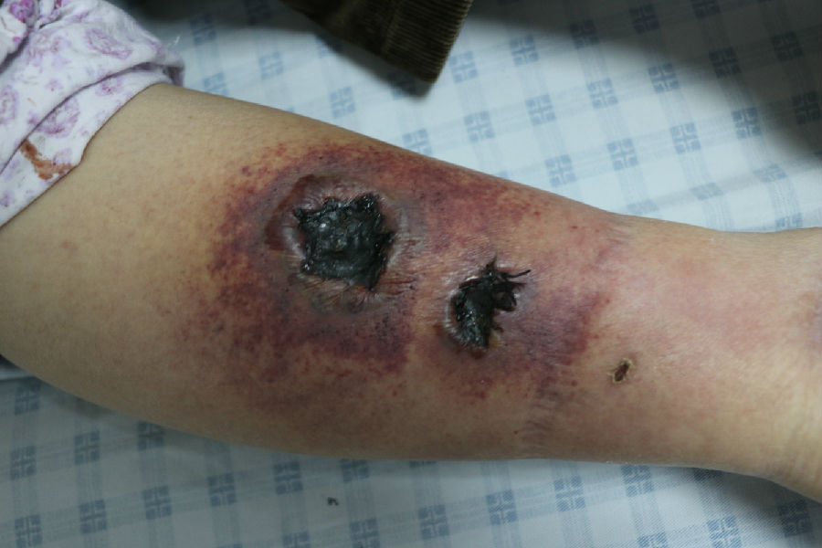 变应性皮肤血管炎