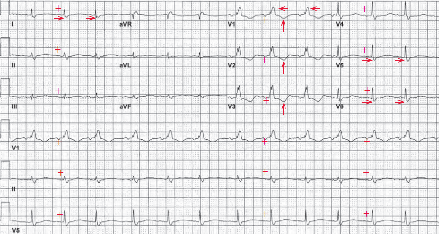 长RP心动过速鉴别,这究竟是哪一种?