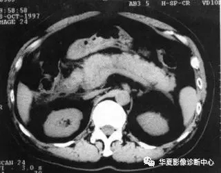 急性胰腺炎的CT分级
