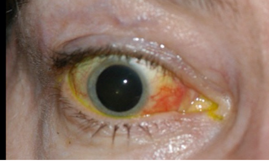 显示海绵窦-颈动脉瘘患者右眼球突眼,结膜水肿和结膜充血