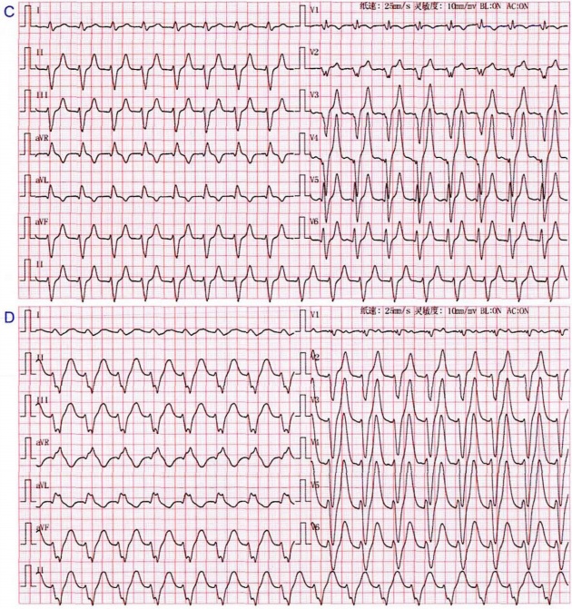心电图危急值解读--终结篇
