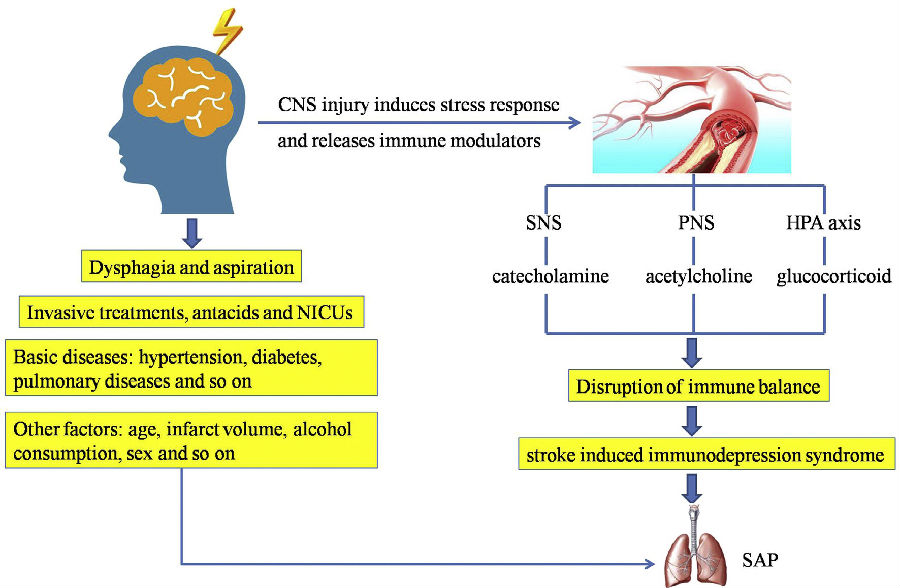 如何预测卒中相关性肺炎,这篇文章来帮你