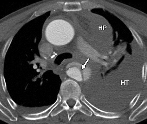 胸、背、腹痛,怀疑夹层?CT平扫,细微之处见功