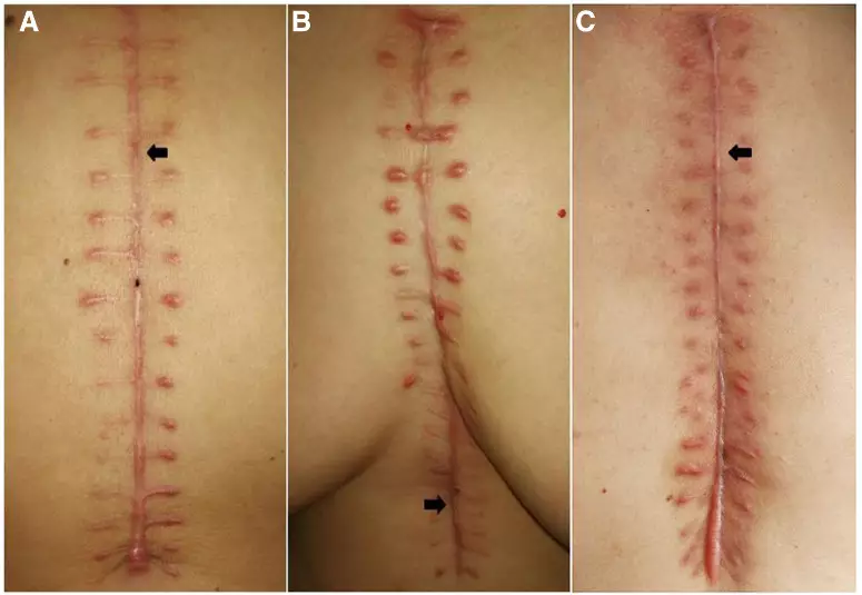 型肉毒毒素预防正中胸骨切开术后增生性瘢痕效