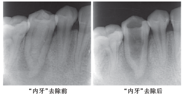 下颌前磨牙牙中牙伴尖周炎1例