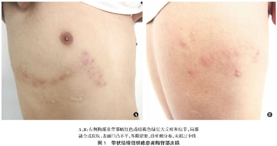 带状结缔组织痣 1 例