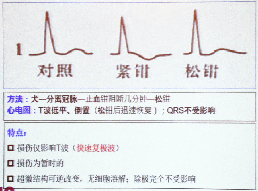 杨伟宪教授:冠心病心肌缺血,如何用心电图进行