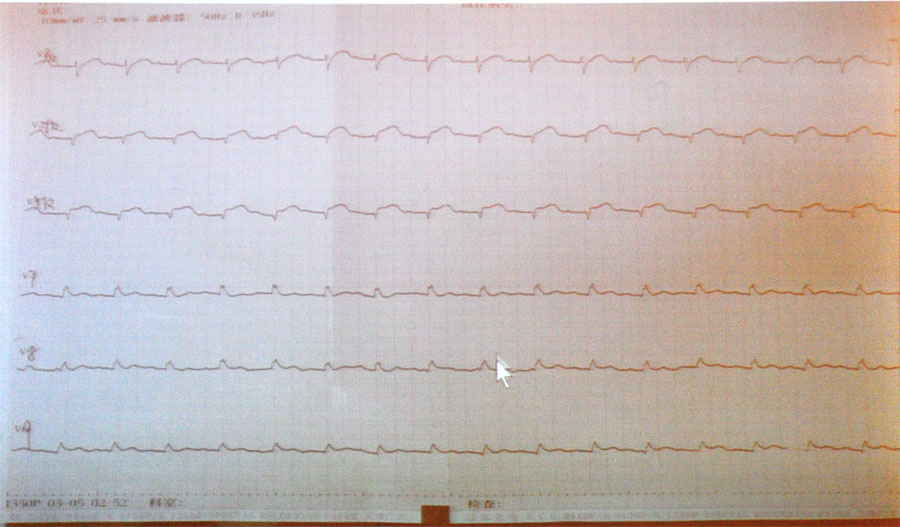 杨伟宪教授:冠心病心肌缺血,如何用心电图进行