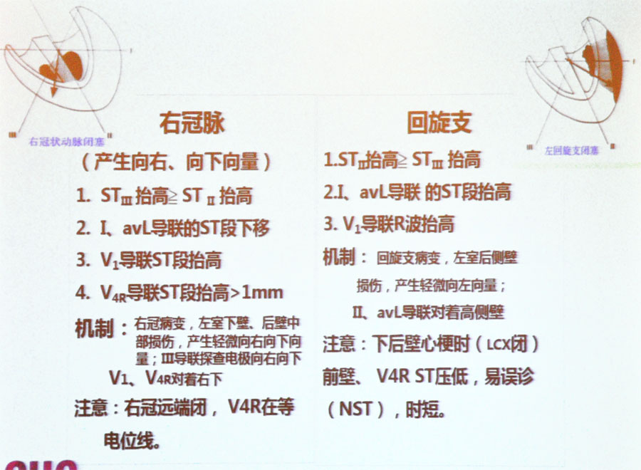 杨伟宪教授:冠心病心肌缺血,如何用心电图进行