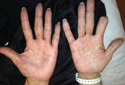 患者出现掌跖皮疹、肝功能异常,怎么回事?