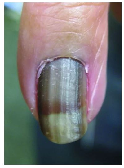 指甲变黑的秘密