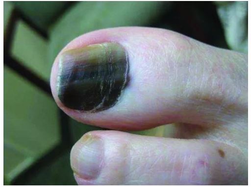 指甲变黑的秘密