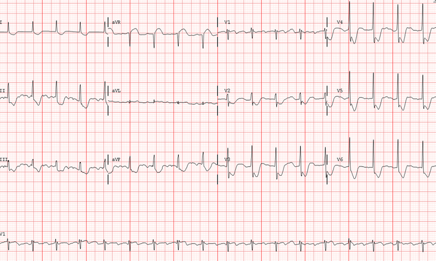 关于洋地黄中毒的10个真相