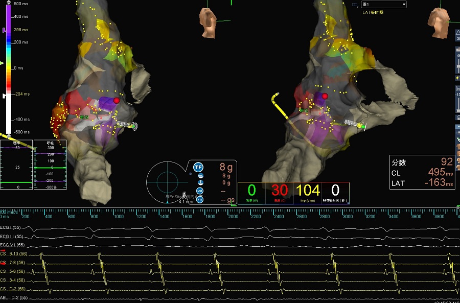 透过现象看本质:房速还是房扑,这是个问题!