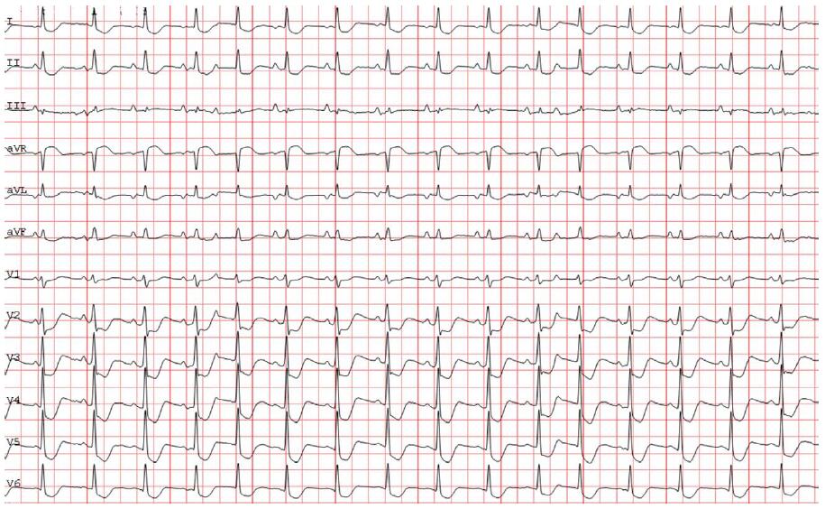 房颤患者突发恶心、呕吐,多导联ST段压低,你想
