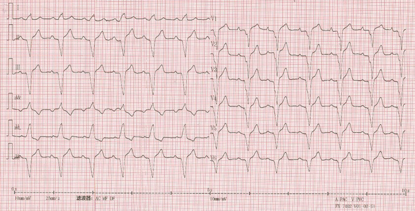狭路相逢!起搏器与乳腺癌同侧,如何处理?